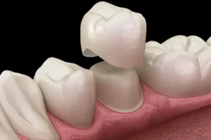 5 Benefits of Zirconia Crowns for Your Child